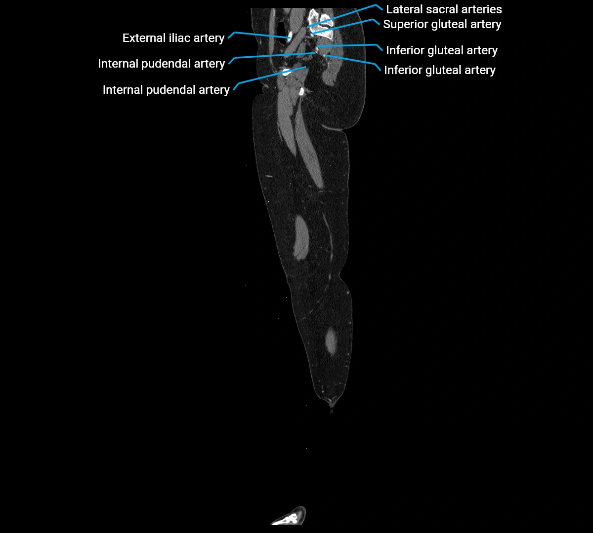 CTA lower limb sagittal cross sectional anatomy labelled image _16 (3).webp